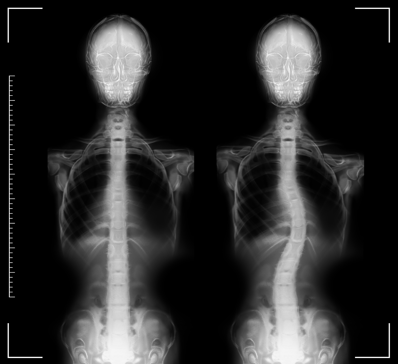 X-rays-of-scoliosis
